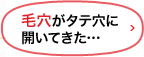毛穴がタテ穴に開いてきた…